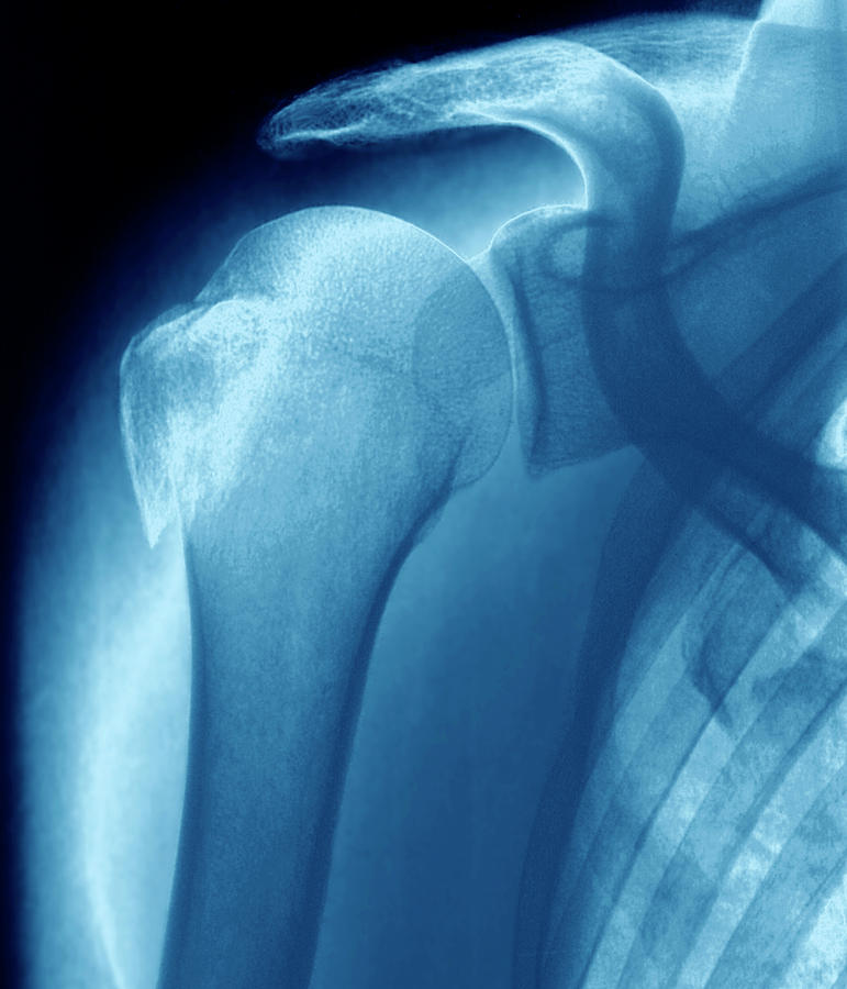 broken-upper-arm-bone-photograph-by-zephyr-science-photo-library