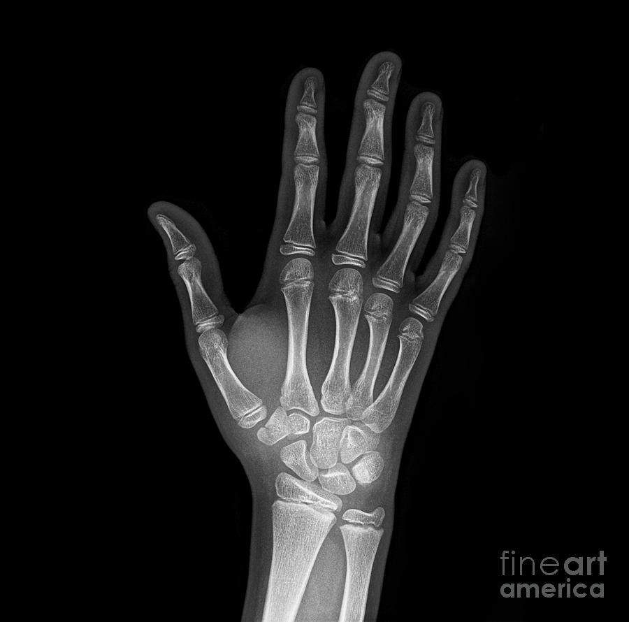 Broken Wrist Bone, X-ray Photograph by Science Photo Library