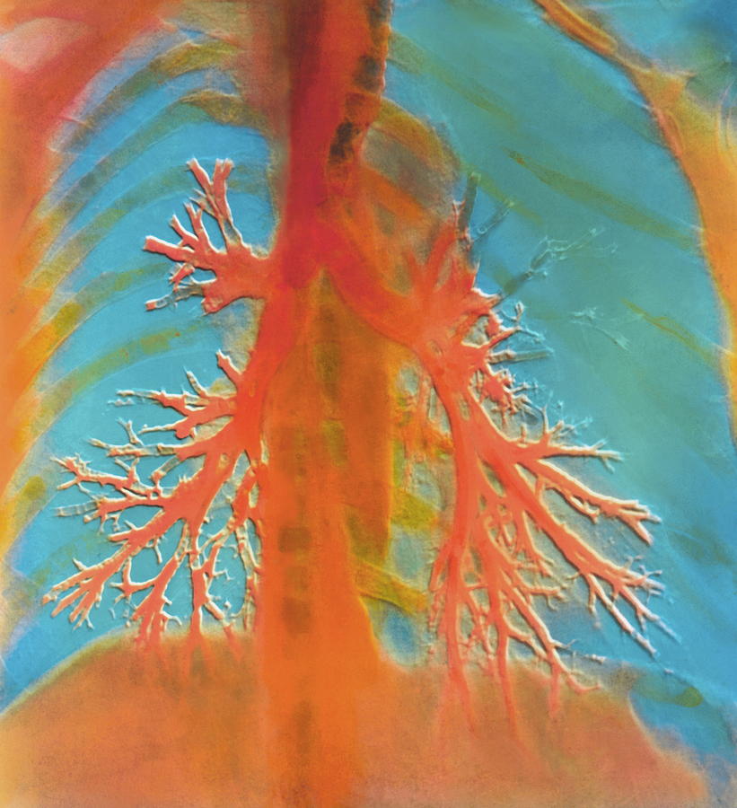 Bronchial Tree Of Lung Photograph by Alain Pol, Ism/science Photo Library