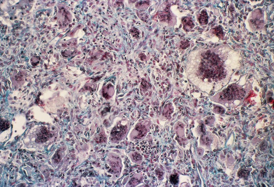 Brown Tumour Photograph by Cnri/science Photo Library - Fine Art America