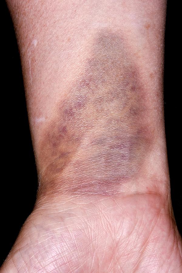 The Bruise by Magdalena Zurawski