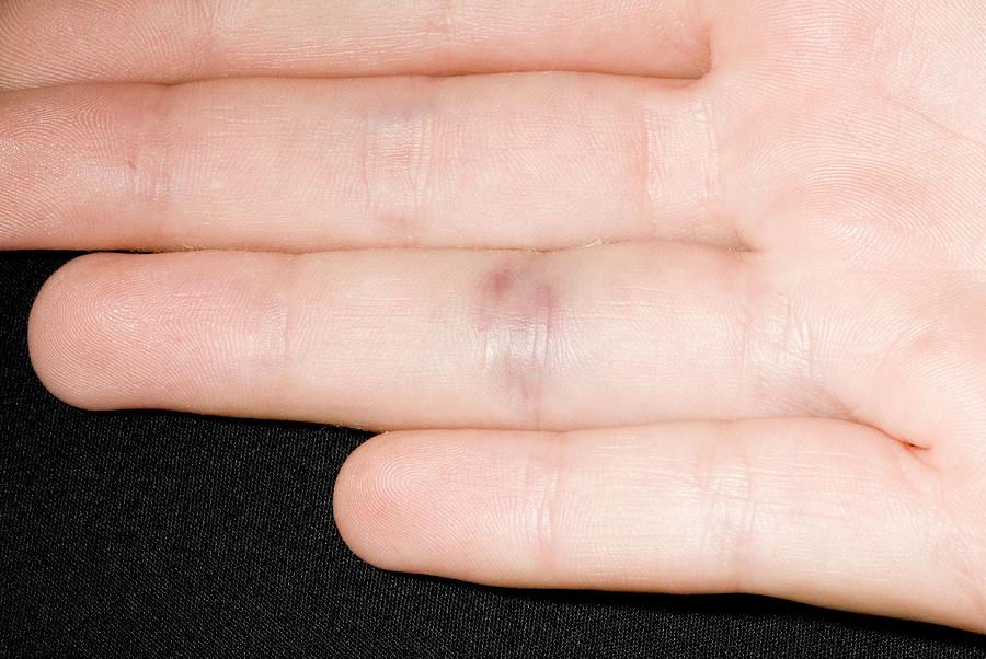 Bruised Finger Photograph by Dr P. Marazzi/science Photo Library