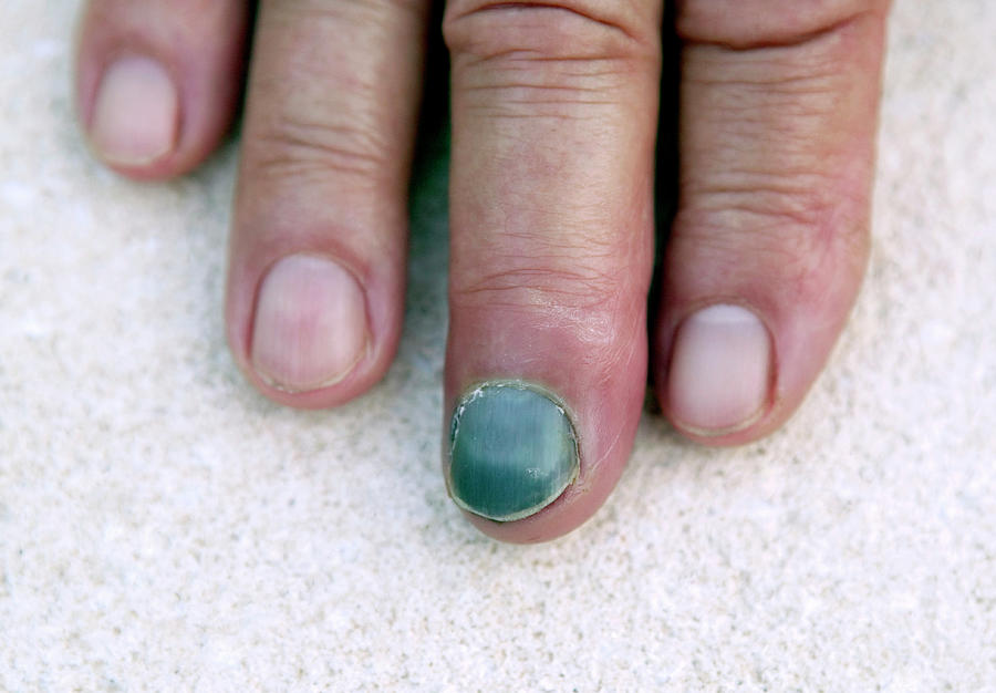 Smashed Fingernail
