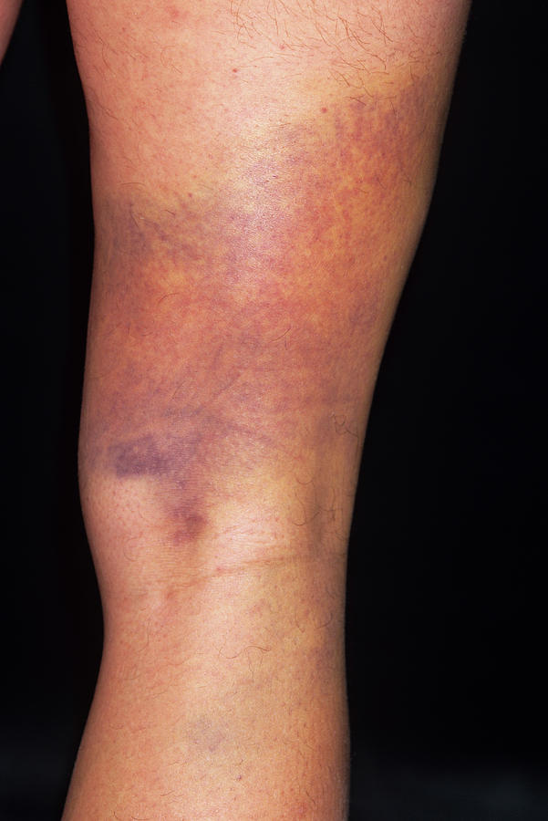 Bruised Thigh Photograph by Dr P. Marazzi/science Photo Library