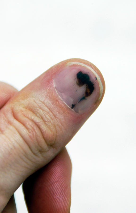Bruised Thumbnail Photograph by Aj Photo/science Photo Library Fine