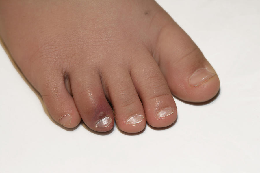 bruised-toe-photograph-by-science-stock-photography