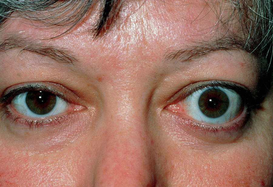 bulging-eye-exophthalmos-due-to-thyrotoxicosis-photograph-by-dr-p