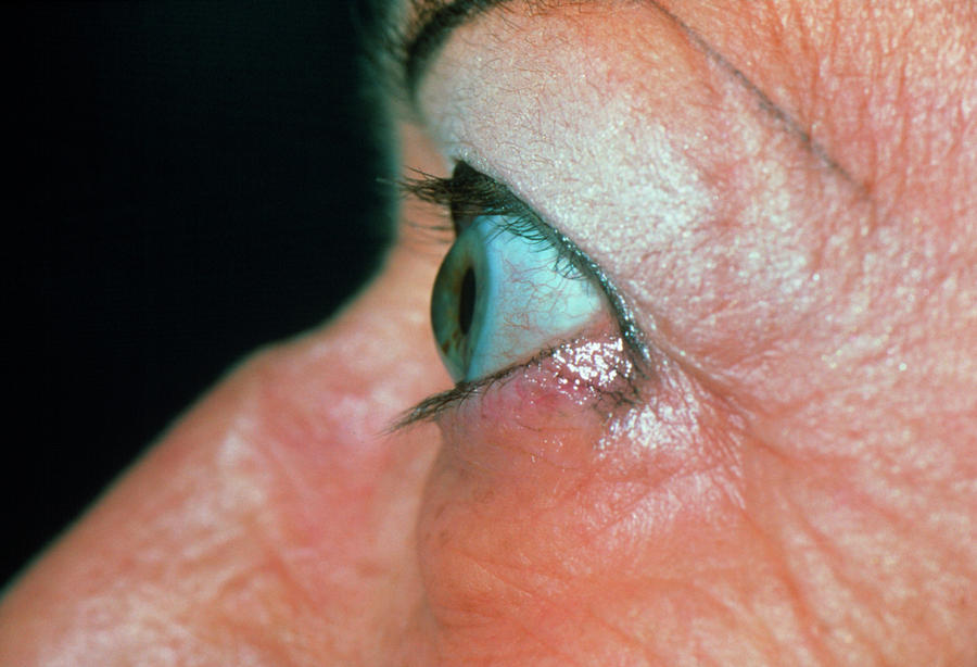 Bulging Eye In Elderly Woman With Graves Disease Photograph By Science