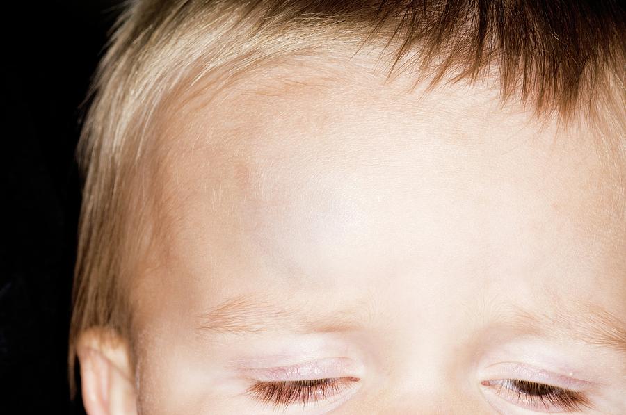 Bump On The Forehead In A Child Photograph by Dr P. Marazzi/science ...