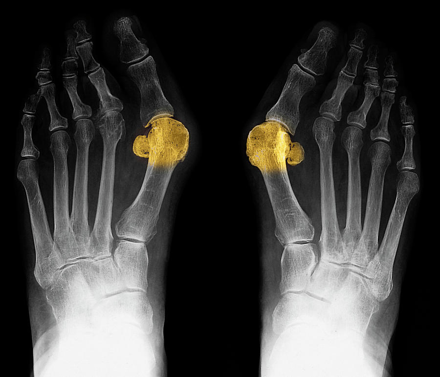 Bunions Photograph by Zephyr/science Photo Library