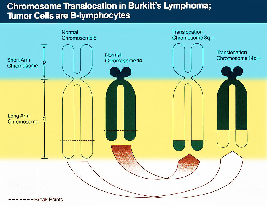Burkitts Lymphoma, Chromosome Diagram Photograph by Science Source