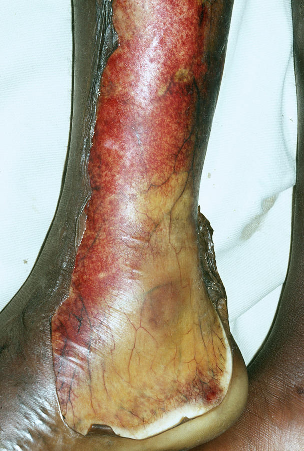 Burnt Leg Photograph by Science Photo Library Burnt Leg Photograph by Science Photo Library