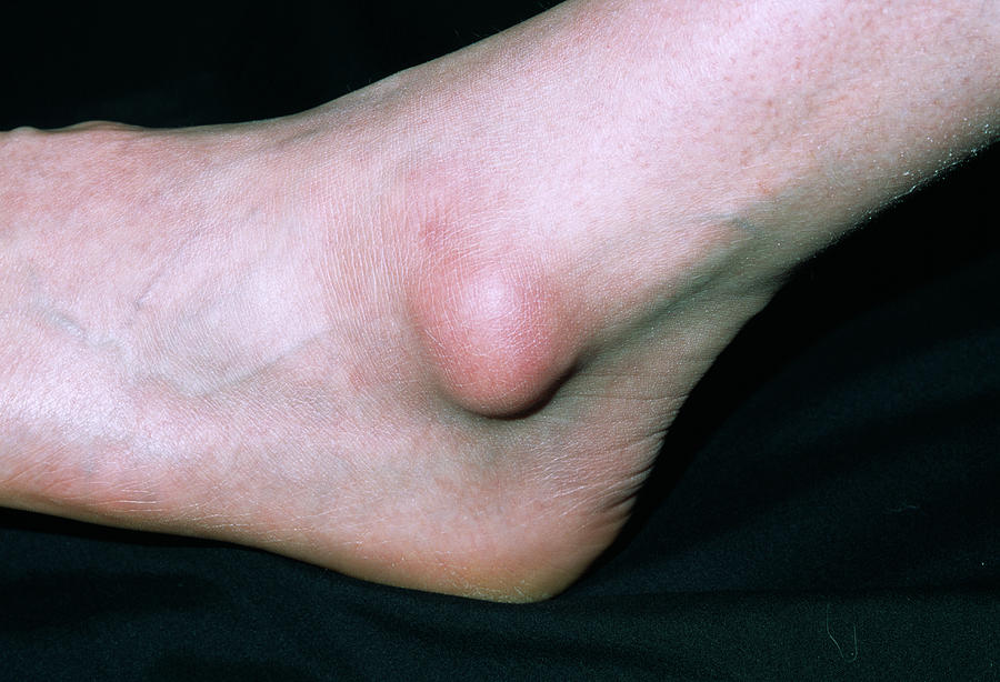 Bursa On Ankle Photograph by Dr P. Marazzi/science Photo Library