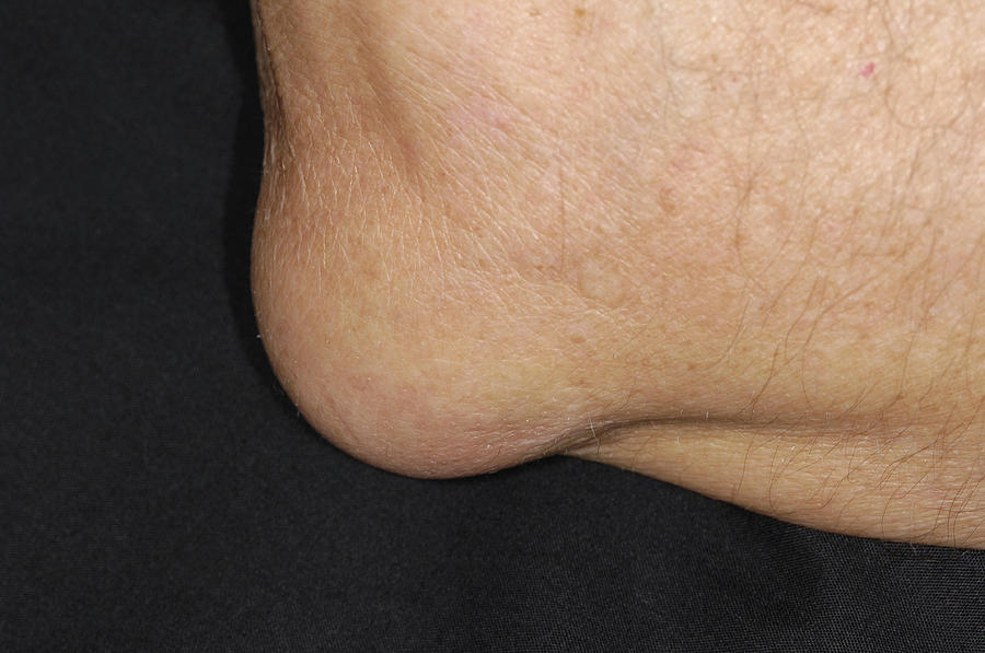 Infected Elbow Bursitis