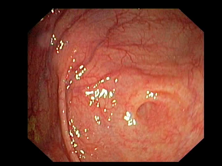 Caecum-appendix Aperture Photograph by Gastrolab/science Photo Library