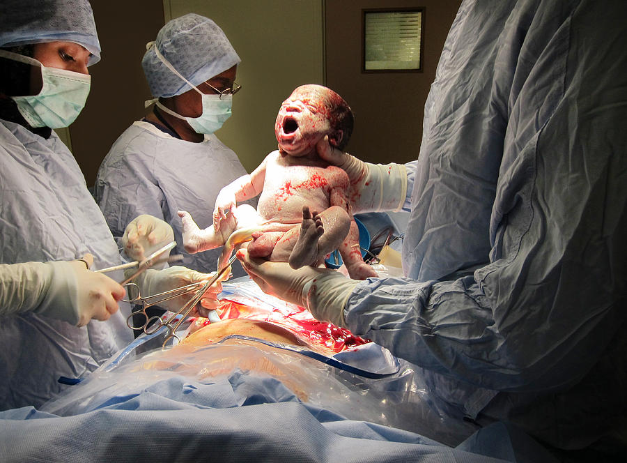 Caesarian babys first breath Photograph by Peter Dazeley