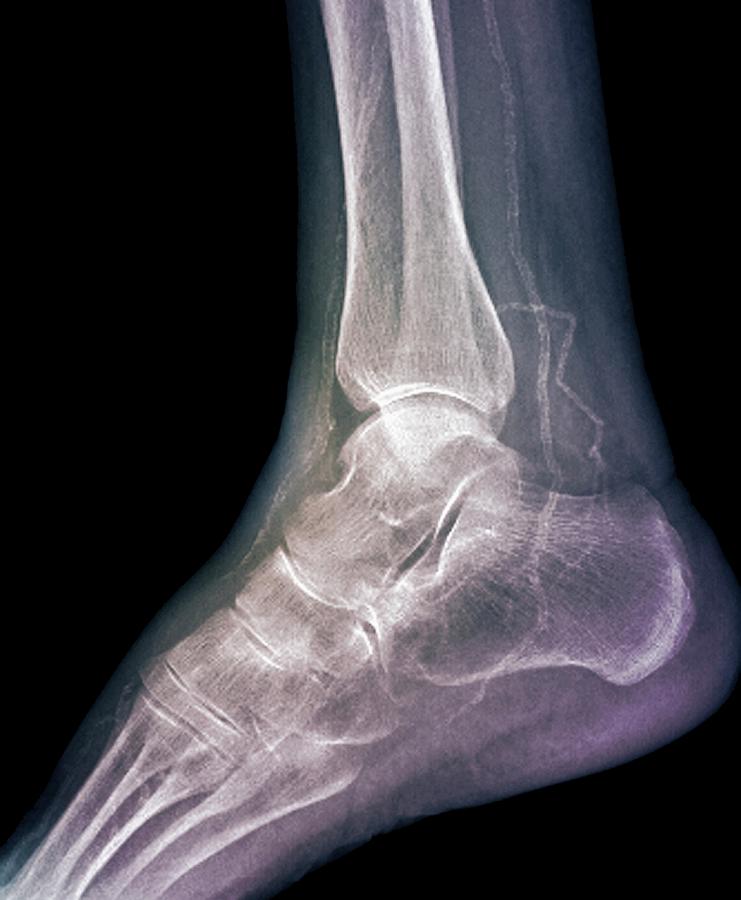 Calcified Ankle Arteries Photograph by Zephyr