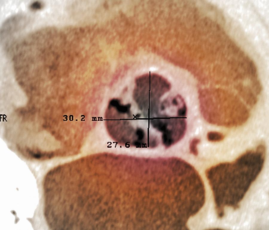 calcified-heart-valve-ct-scan-photograph-by-science-photo-library