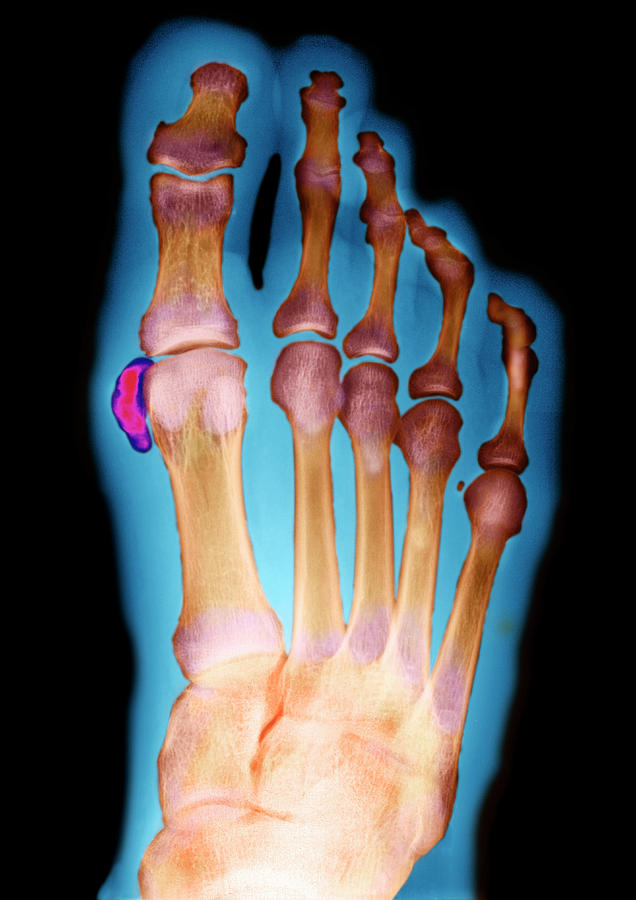 Calcified Toe Bone Photograph by Aj Photo/science Photo Library