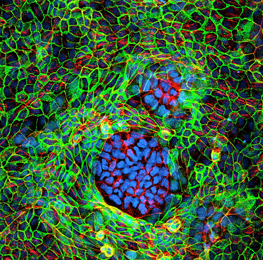 Cancer Cells Photograph by 