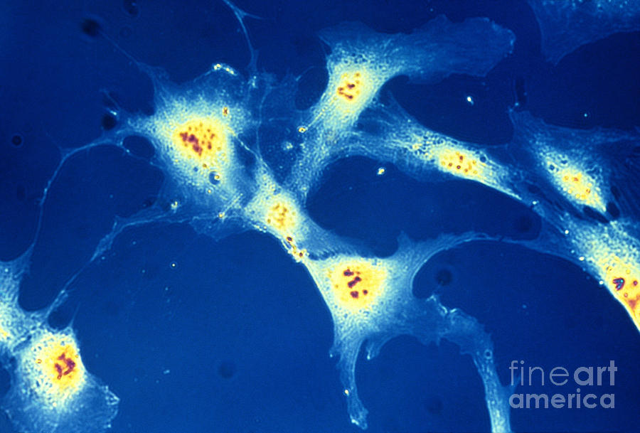 Cancer Cells Photograph by Dr Cecil H Fox