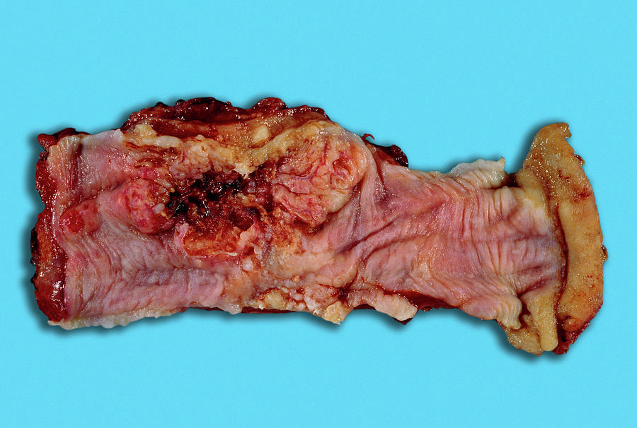 Oesophagus Photograph - Cancer Of The Oesophagus by Medimage/science Photo Library