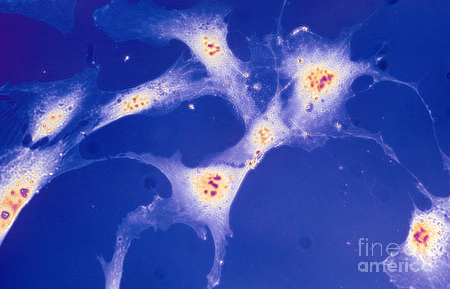 Pathology Photograph - Cancerous Tumor Cells by Dr. Cecil H. Fox