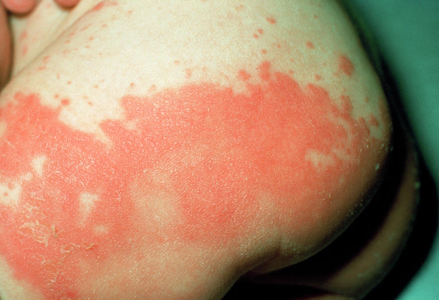 Candiasis Rash On Infant s Buttocks By Science Photo Library 