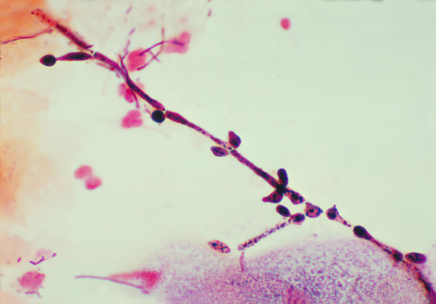 Candida Albicans, Vaginal Smear, Lm Photograph by Science Source