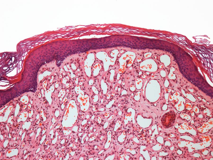 Capillary Hemangioma Photograph By Steve Gschmeissner Science Photo Library Fine Art America