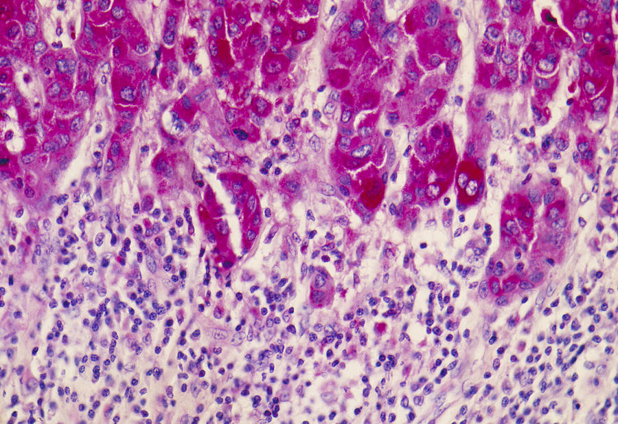 Carcinoma In Breast Tissue Photograph by Michael Abbey
