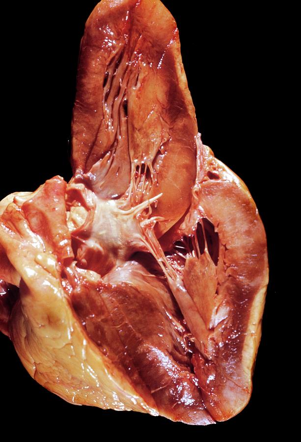 Cardiac Amyloidosis Photograph by Pr. M. Forest - Cnri