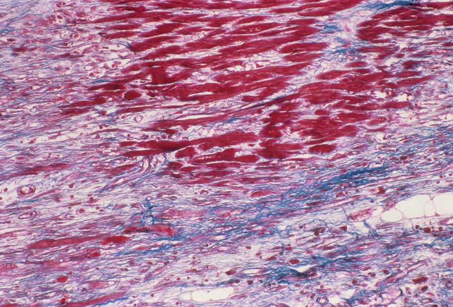 Cardiomyopathy Photograph by Science Photo Library Cardiomyopathy Photograph by Science Photo Library