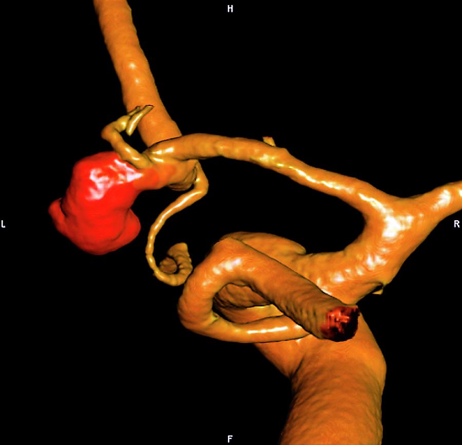 Carotid Aneurysm Photograph by Zephyr/science Photo Library