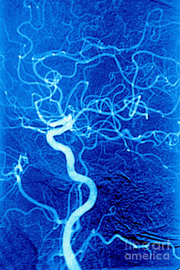 Carotid Angiography Photograph by James Cavallini