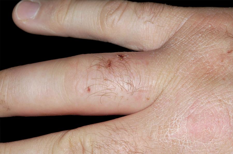 Cat Bite Wound On The Finger Photograph by Dr P. Marazzi/science Photo ...