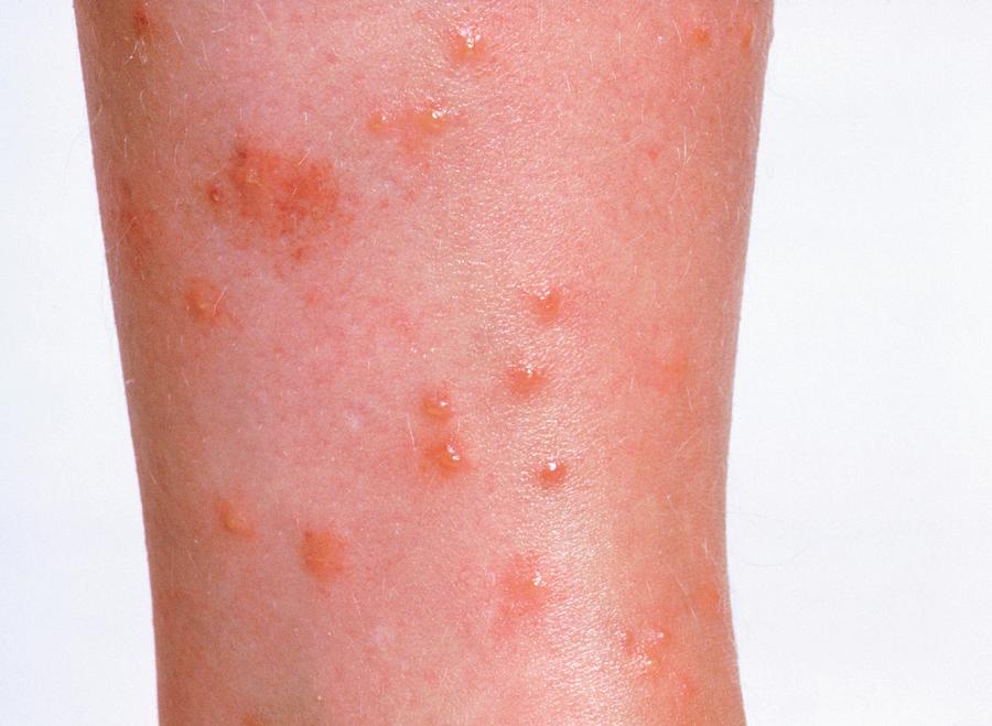 Cat Flea Bites On Cats