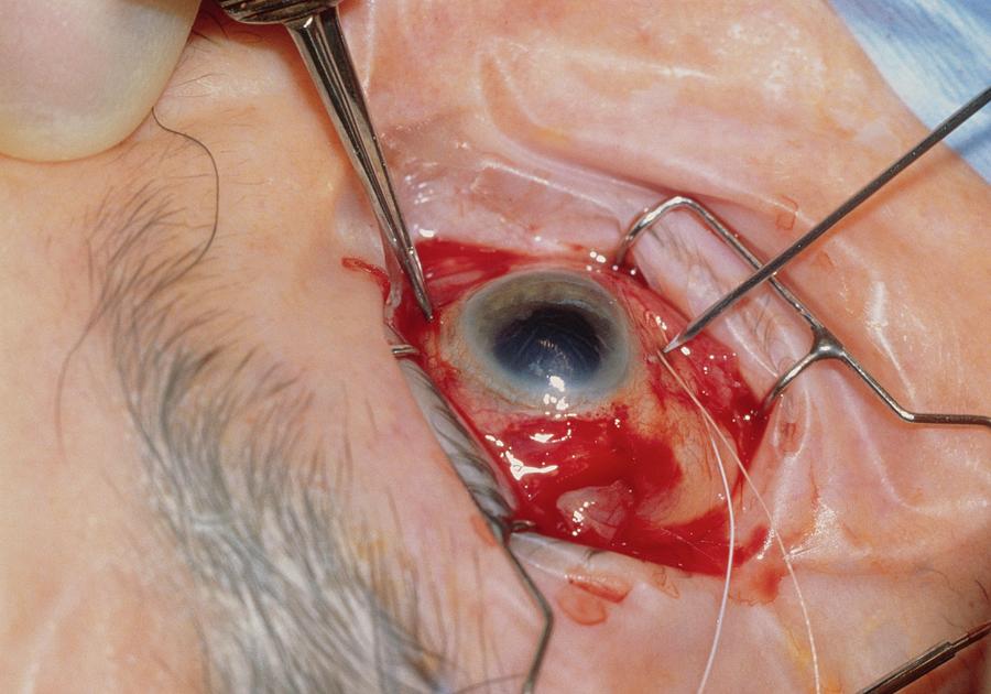 Cataract Surgery: Process Of Removing Eye Lens Photograph ...