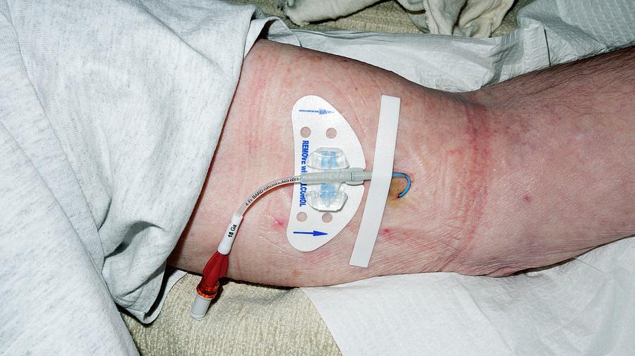 Catheter In Arm Of Cancer Patient Photograph by Georgette Douwma