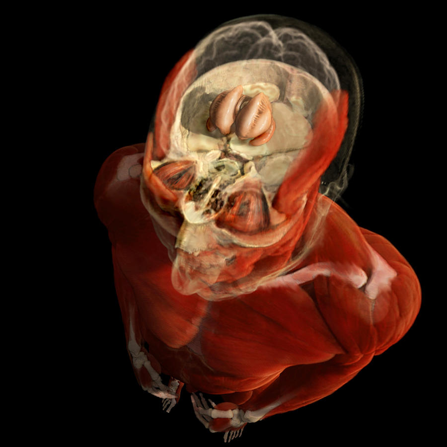Caudate Nucleus, Brain Photograph by Anatomical Travelogue
