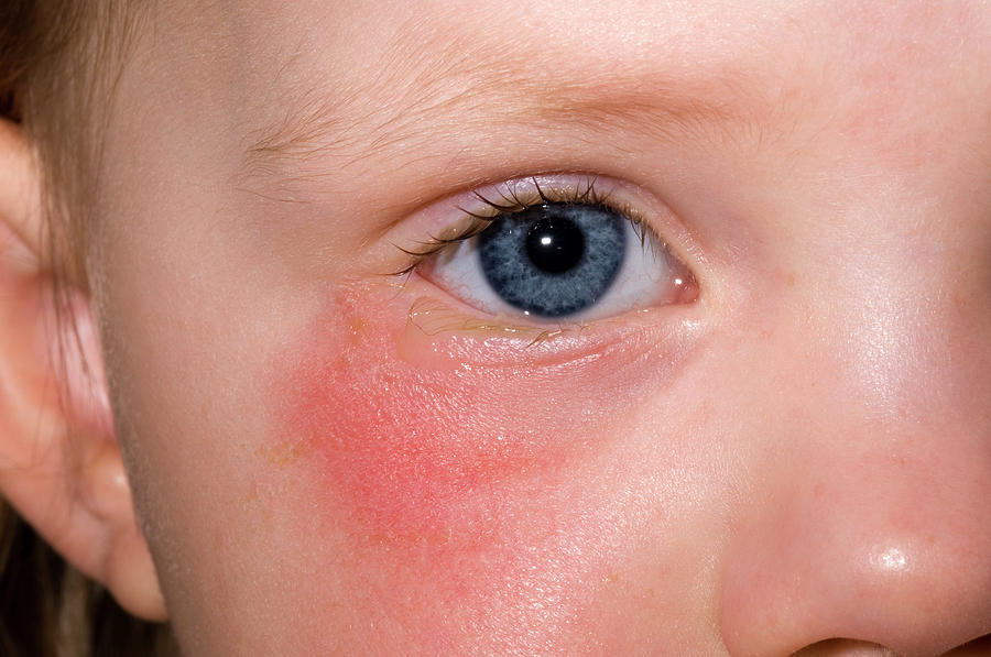 Cellulitis And Conjunctivitis Photograph By Dr P Marazziscience Photo