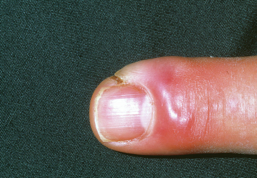 Cellulitis Infection On A Finger Photograph by Dr P. Marazzi/science ...