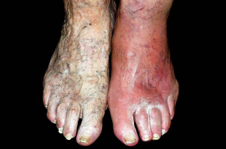 Cellulitis Of The Foot Photograph By Dr P Marazziscience Photo Library