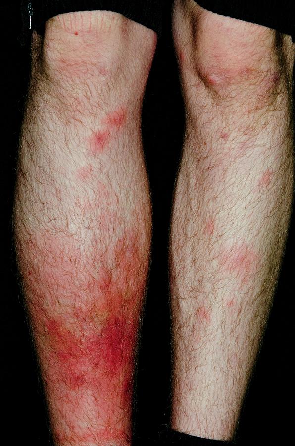 cellulitis-of-the-leg-after-insect-bites-photograph-by-dr-p-marazzi