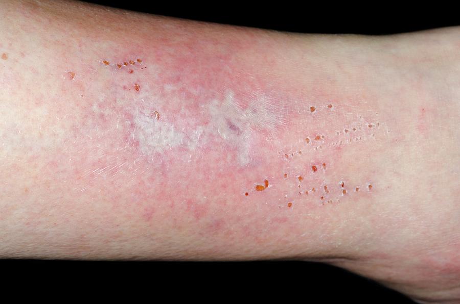 Cellulitis On The Shin Photograph by Dr P. Marazzi/science Photo Library