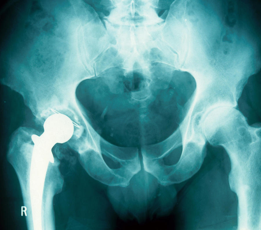 Cement Failure In Joint Replacement Photograph by John Watney