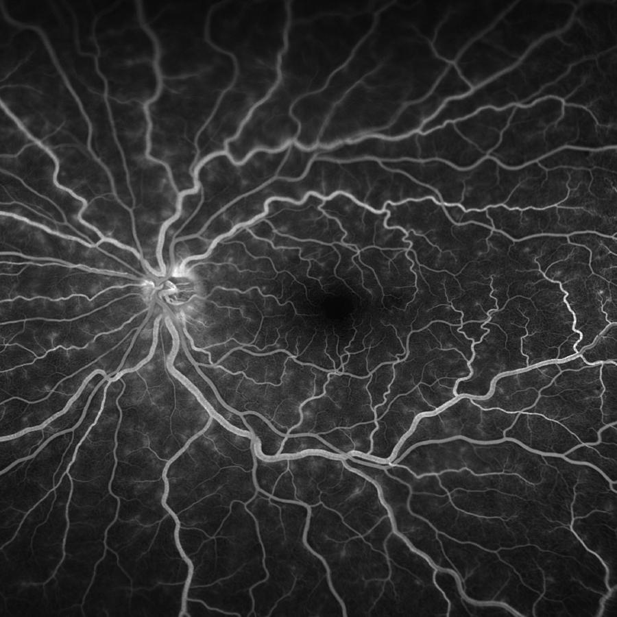 Central Retinal Vein Occlusion Photograph by Paul Whitten