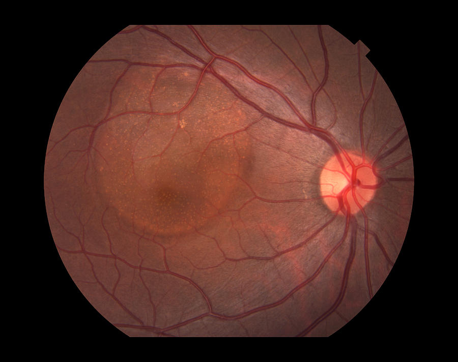 Central Serous Retinopathy Photograph by Paul Whitten - Fine Art America