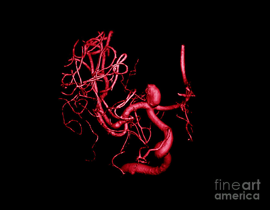 Cerebral Aneurysm, 3d Scan Photograph by Living Art Enterprises