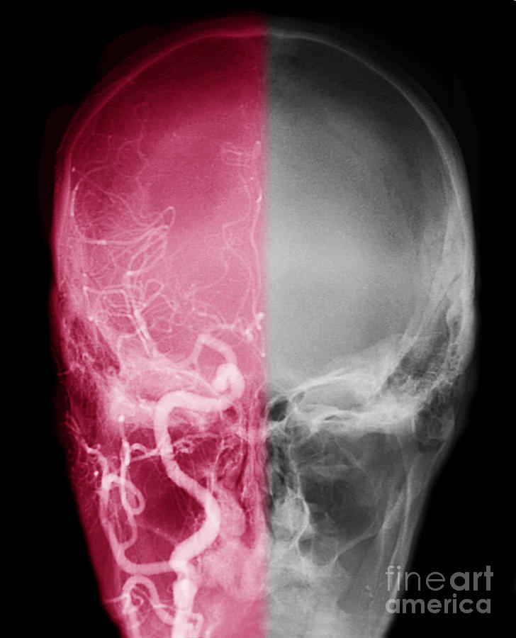 Cerebral Angiogram Photograph by Scott Camazine